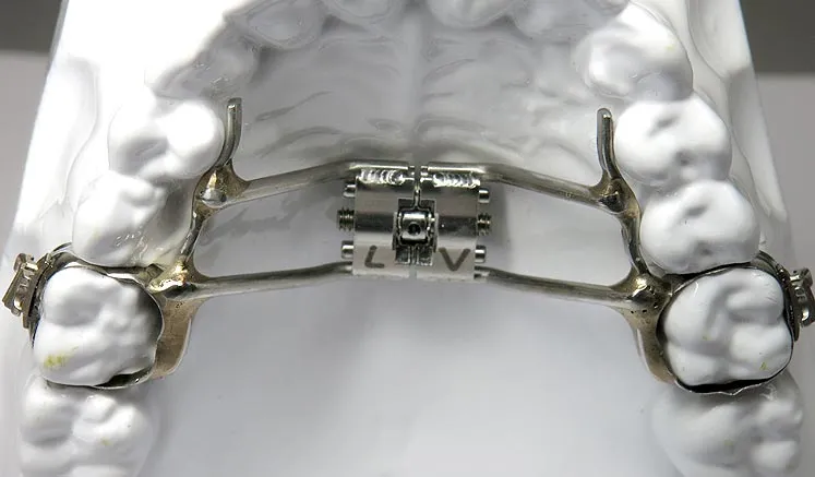 Disjoncteurs orthodontiques